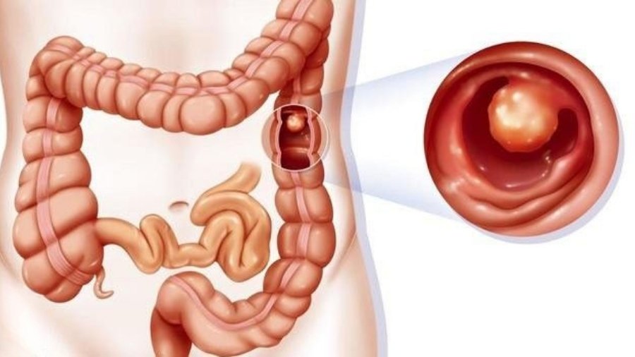 علائم احتمالی پولیپ روده