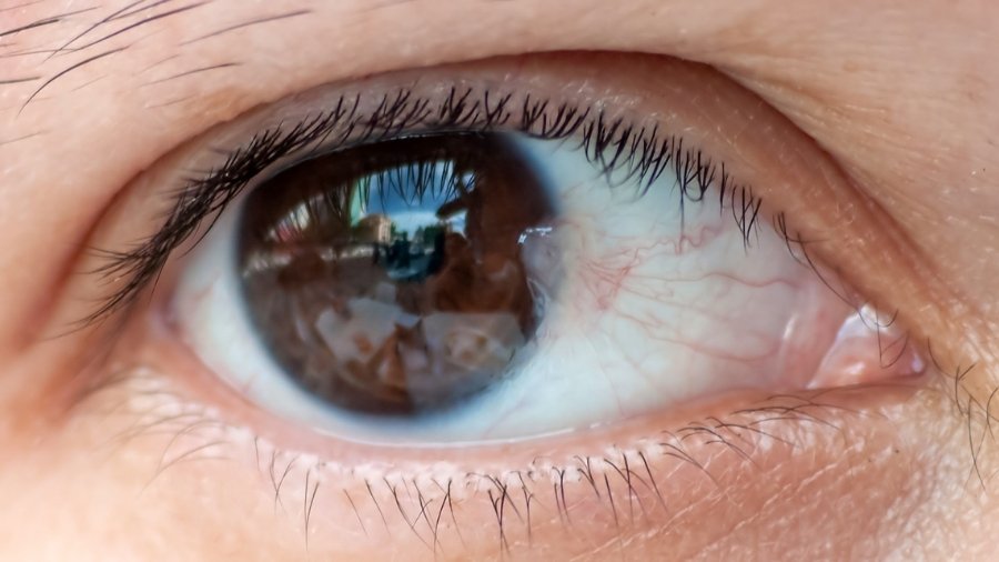 ناخنک چشم چیست؟